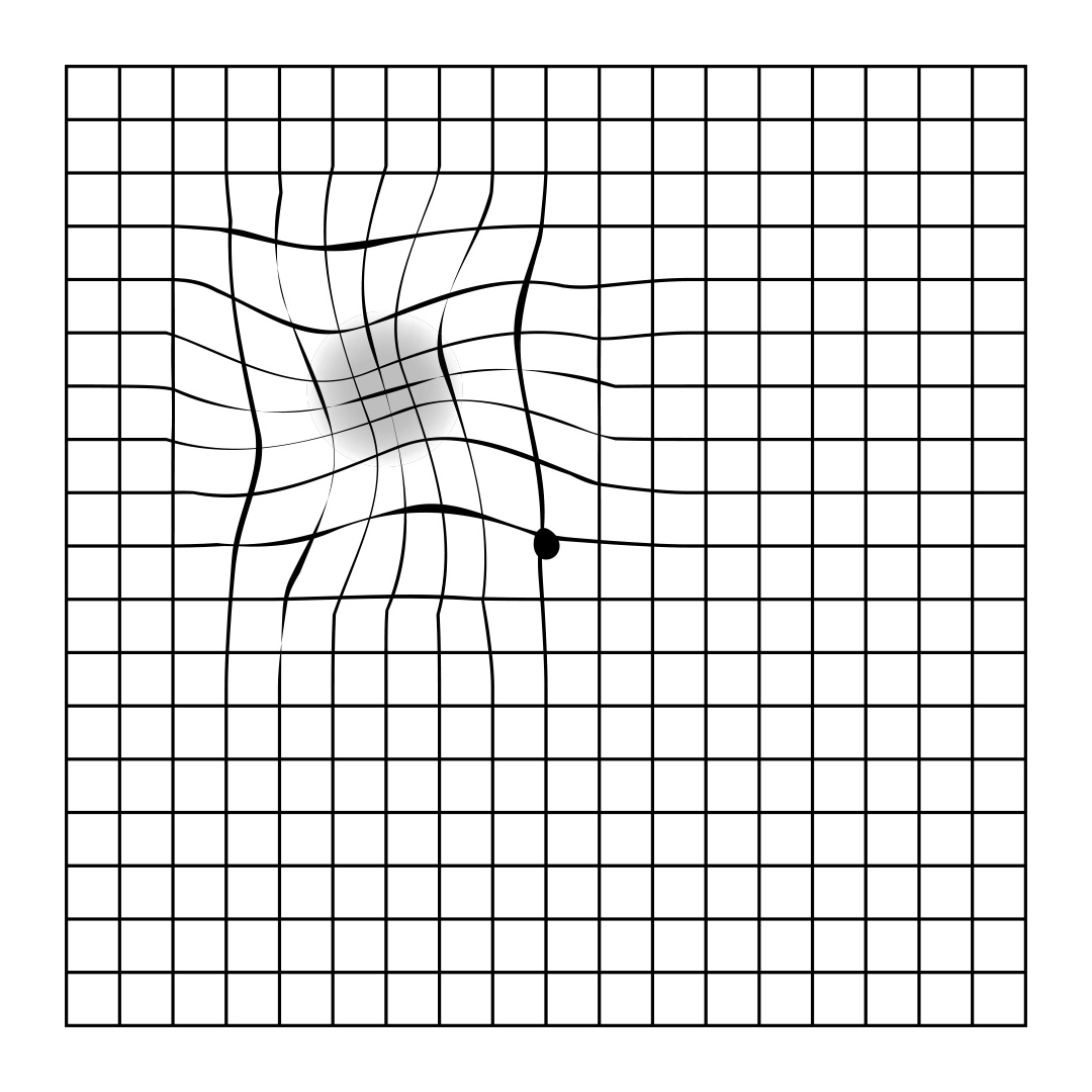 Amsler Grid Macular Degeneration Test At Home Lentiamo